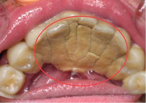 几乎人人都会得牙结石,别以为你逃得掉,快看牙结石的3种症状!