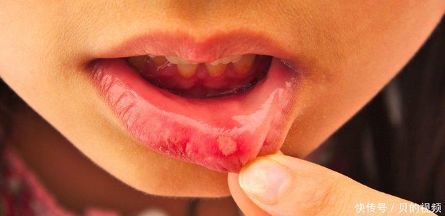 男子嘴肿溃烂元凶不是上火 四症状小心唇癌 快资讯 男子嘴肿溃烂元凶不是上火 四症状小心唇癌 快资讯