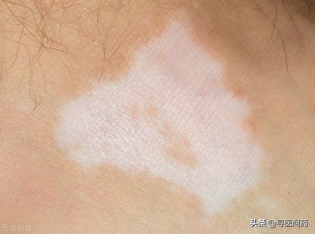 68岁老太私处痛痒开裂 自创盐洗方法 结果致外阴白斑 快资讯