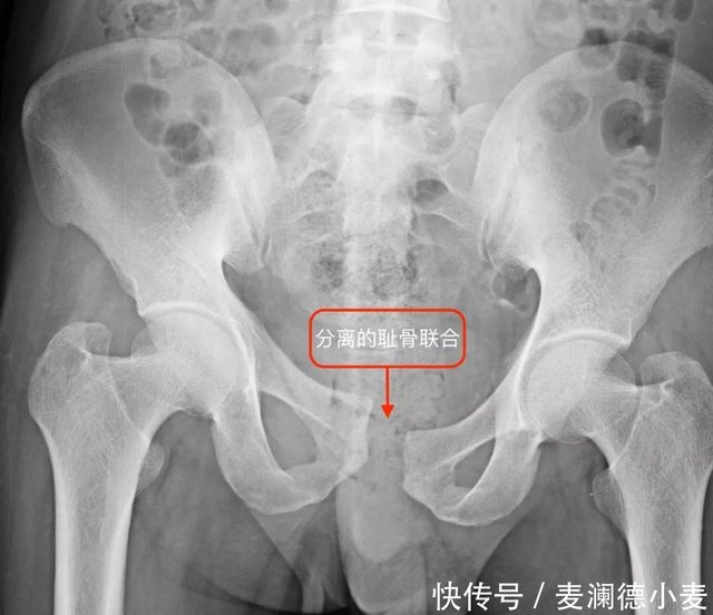 不发则已 一发疼到怀疑人生 产后耻骨联合分离 快资讯 不发则已 一发疼到怀疑人生 产后耻骨联合分离 快资讯