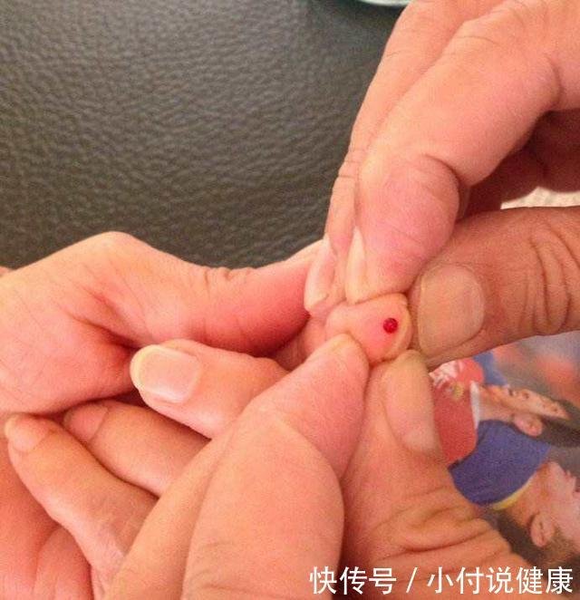 神奇的刺血疗法系列之十宣放血 快资讯
