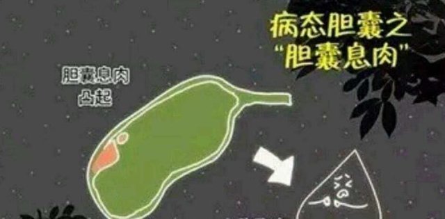 胆囊息肉怎么办 需要手术么 快资讯