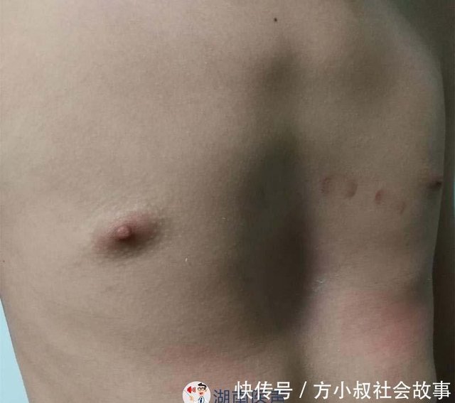 14岁男孩胸骨凹陷畸形 家长竟误认为佝偻病让其狂吃钙片 快资讯 14岁男孩胸骨凹陷畸形 家长竟误认为佝偻病让其狂吃钙片 快资讯