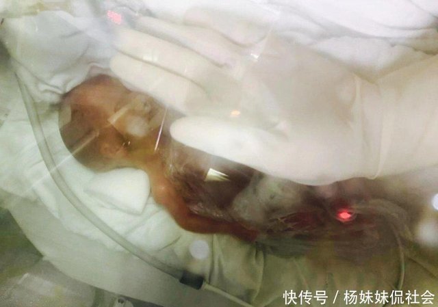 出生不到1斤1两 26周超早产女婴奇迹存活 功不可没 快资讯