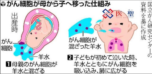 世界首例因母体子宫颈癌分娩时癌细胞混入羊水导致新生儿肺癌 快资讯