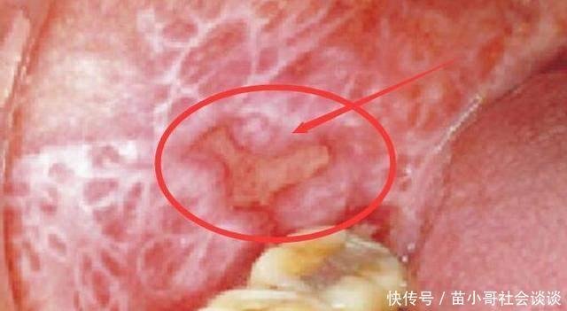 舌头上长出口腔溃疡, 不料是舌癌, 舌癌早期有哪些症状- 快资讯