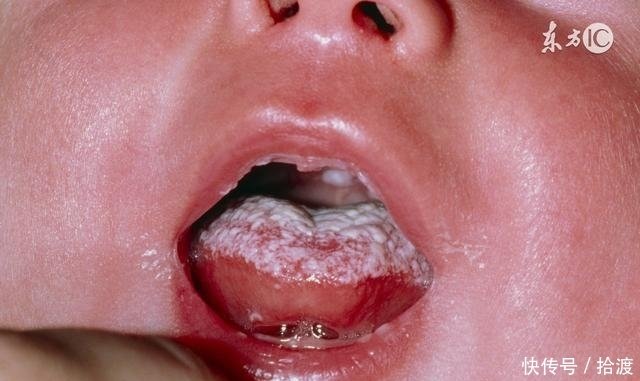 宝宝嘴巴里都是白白的白膜怎么办 其实这是鹅口疮 教你一招搞定 快资讯