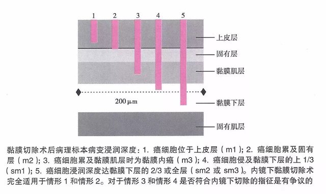 食管癌内镜下黏膜剥离术 Esd 黏膜切除 Emr 快资讯