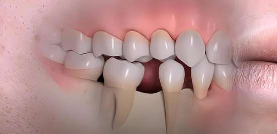 拔牙后不种牙空着有什么影响