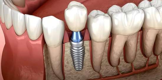 牙冠修复和种植牙哪个更好