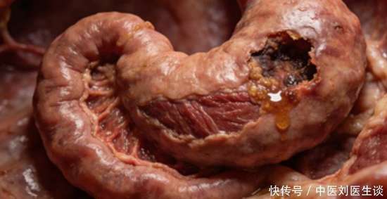 胃溃疡反复发作怎么办