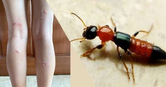 隐翅虫毒性超强