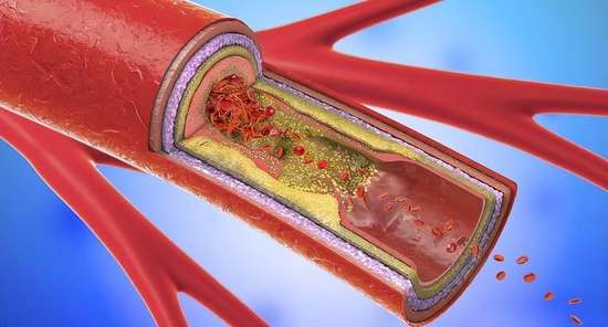 冠心病千万别碰的五种食物