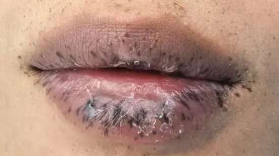 嘴唇突然出现很多纹路怎么回事