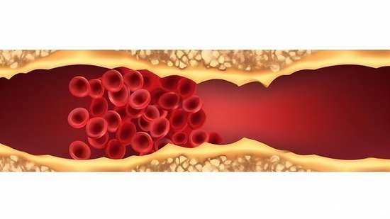 动脉疾病早期的3个信号