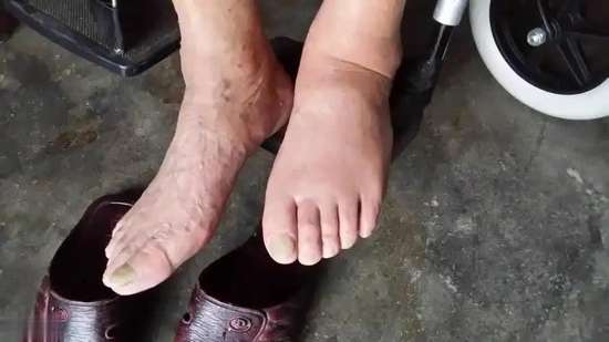 专家讲血栓的症状图片