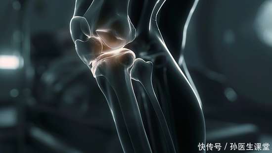 48岁女膝关节炎怎么治