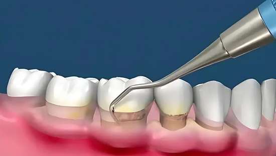 牙周病刮治视频