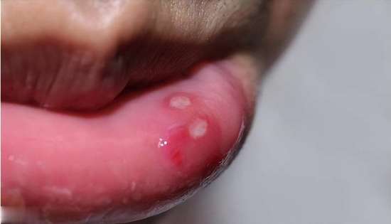 嘴巴长溃疡怎么办