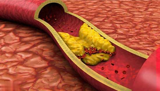 高胆固醇不能吃坚果吗