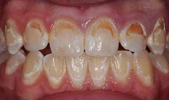 每天刷一次牙和两次牙的区别