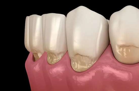 牙齿楔状缺损一定要补牙吗