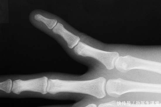 48岁女膝关节炎怎么治