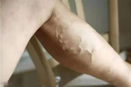 专家讲血栓的症状图片