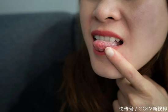 嘴角起泡不一定是上火