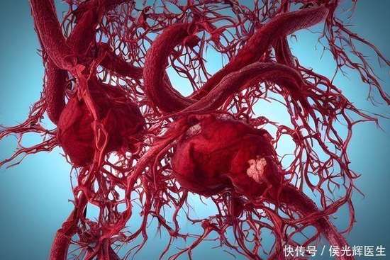 动脉疾病早期的3个信号