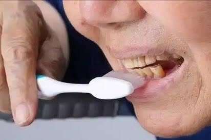 饭后刷牙损伤牙釉质