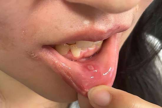 口腔出现五种迹象或是癌症的信号