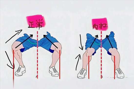改善膝盖内扣的方法