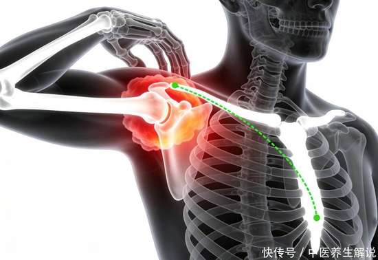 肩周炎拔罐可以根治吗