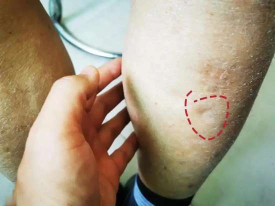 专家讲血栓的症状图片