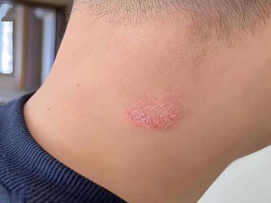 嘴巴长溃疡怎么办