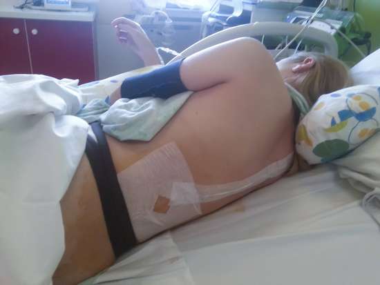 剖宫产术后疼痛难忍怎么办