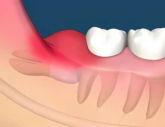 长了智齿一定要拔吗