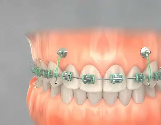牙齿矫正对年龄有要求吗