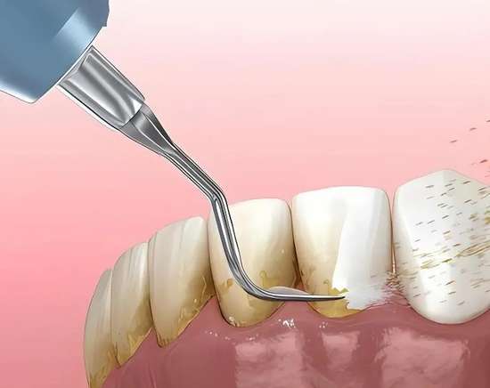 洗牙后牙缝变大真相