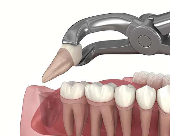 牙齿矫正一定要拔智齿吗