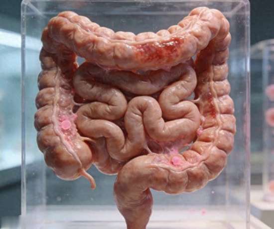 肠易激综合征是肠道啥毛病