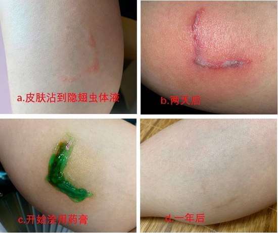 隐翅虫毒性超强