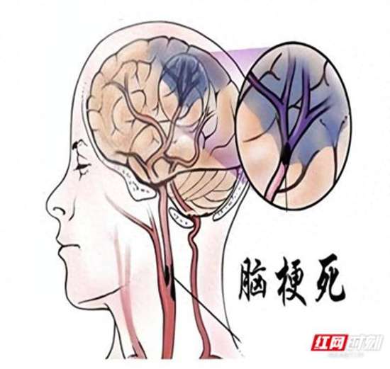 60岁大叔突发脑梗