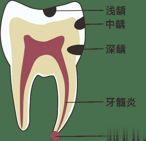 牙齿磨小会引起牙髓炎吗