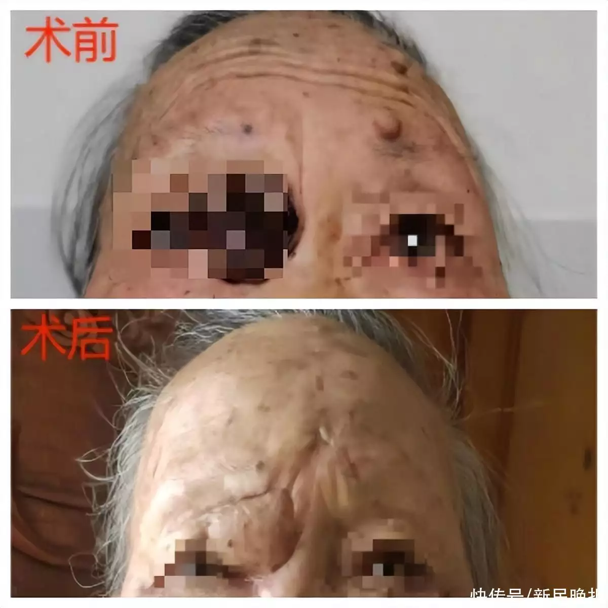 眼角上的“黑痣”野蛮生长？竟然是皮肤恶性肿瘤！仁济医院多学科联手：祛除肿瘤护光明保外观轻度抑郁症的人，多半会有这6句“口头禅”，希望你一句都没说过