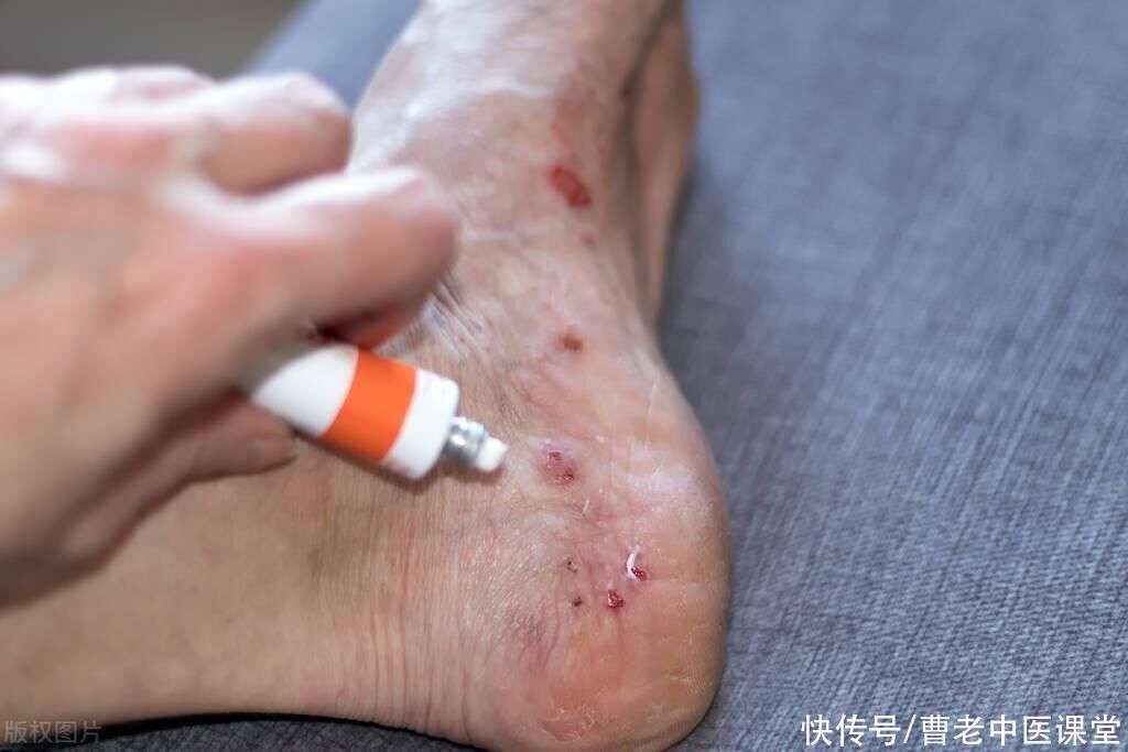 发热后脚上起红疹子怎样回事