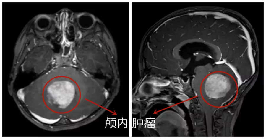 儿医说丨孩子反复头痛、呕吐，注意警惕脑肿瘤毛主席问邓小平和王洪文：我死后中国会怎样？邓小平回答了八个字