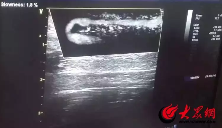 重点专科推介 | 枣庄市立医院肾内科瓦妮莎厘革大，减重40斤，找回模特身材，和加索尔自拍，笑容辉煌光耀（内科好的医院）枣庄市立医院刘春希简介，