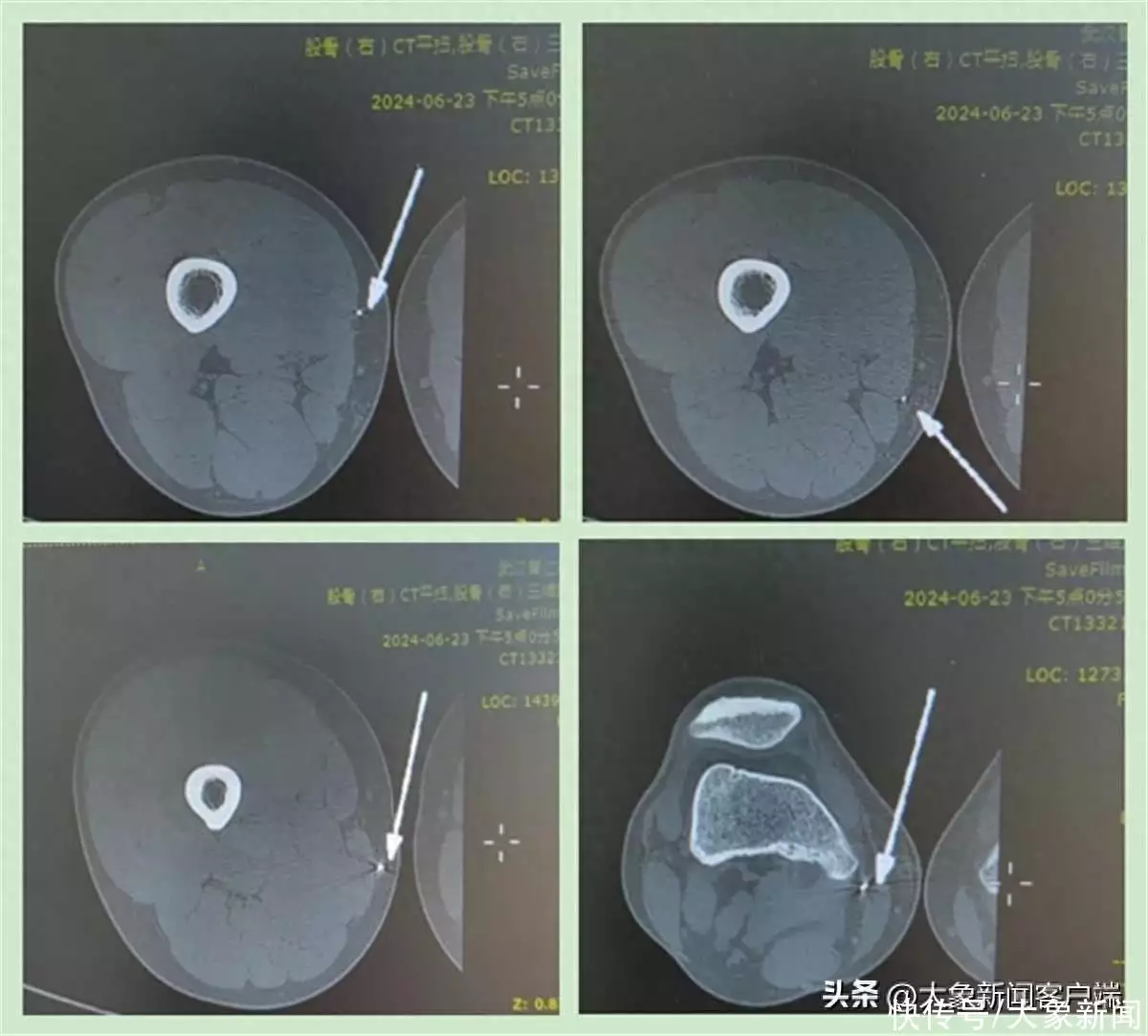 铁屑喷射刺入大腿，男子效仿电影桥段用磁铁吸碎片致伤上加伤